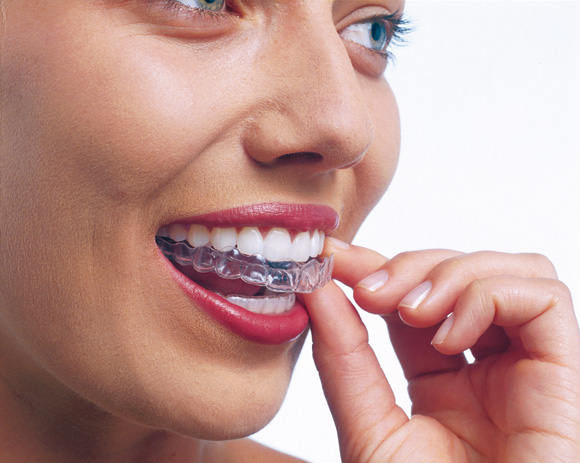 Fino a 1000 euro di sconto sui trattamenti Invisalign