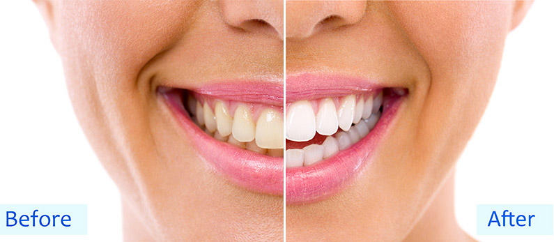Denti più bianchi?